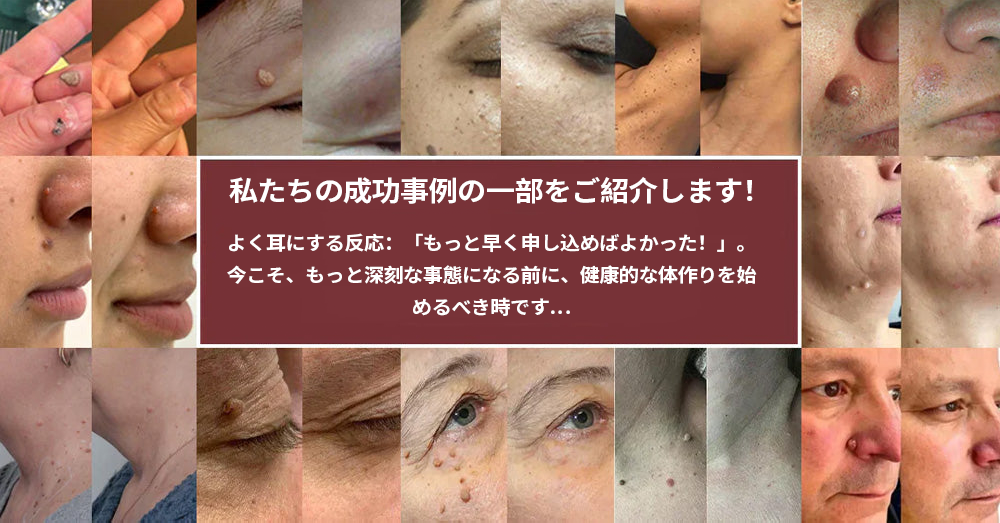 🔥Curalona® 2-in-1 マイクロニードル＆ハイドロコロイドパッチ🔥 | 隆起したほくろ、ニキビ、扁平イボ、皮膚線維腫を除去 | シワ、傷跡、肌の気になる部分の改善をサポート | 顔や体に使える目立たないパッチ