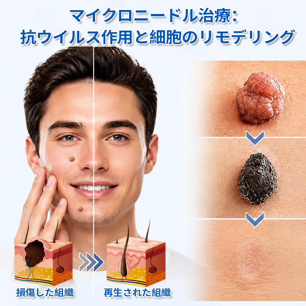 🔥Curalona® 2-in-1 マイクロニードル＆ハイドロコロイドパッチ🔥 | 隆起したほくろ、ニキビ、扁平イボ、皮膚線維腫を除去 | シワ、傷跡、肌の気になる部分の改善をサポート | 顔や体に使える目立たないパッチ
