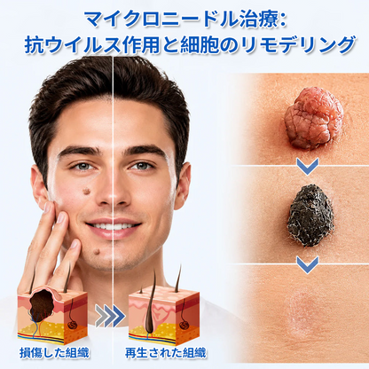 🔥Curalona® 2-in-1 マイクロニードル＆ハイドロコロイドパッチ🔥 | 隆起したほくろ、ニキビ、扁平イボ、皮膚線維腫を除去 | シワ、傷跡、肌の気になる部分の改善をサポート | 顔や体に使える目立たないパッチ