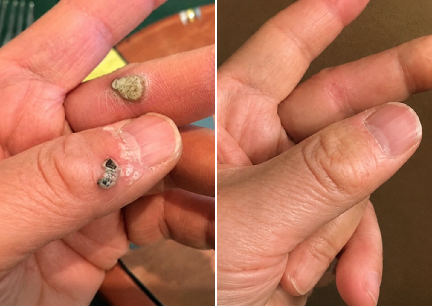 🔥Curalona® 2-in-1 マイクロニードル＆ハイドロコロイドパッチ🔥 | 隆起したほくろ、ニキビ、扁平イボ、皮膚線維腫を除去 | シワ、傷跡、肌の気になる部分の改善をサポート | 顔や体に使える目立たないパッチ